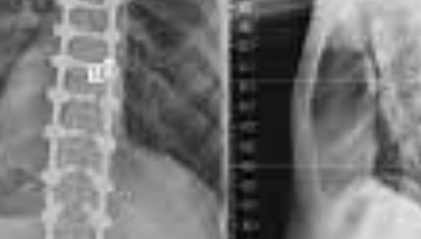 عملية تعديل اعوجاج العمود الفقري في الهند